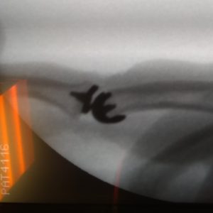 zdjecie-RTG-endoprotezy-kciuka